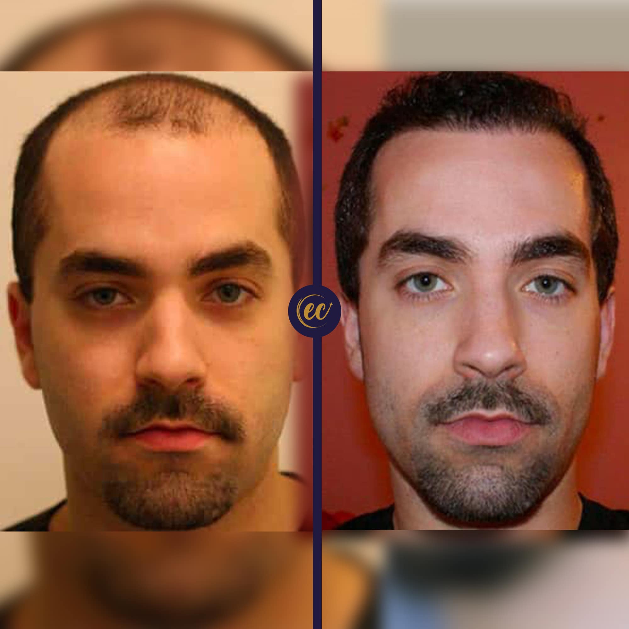 Hair Transplant in Turkey