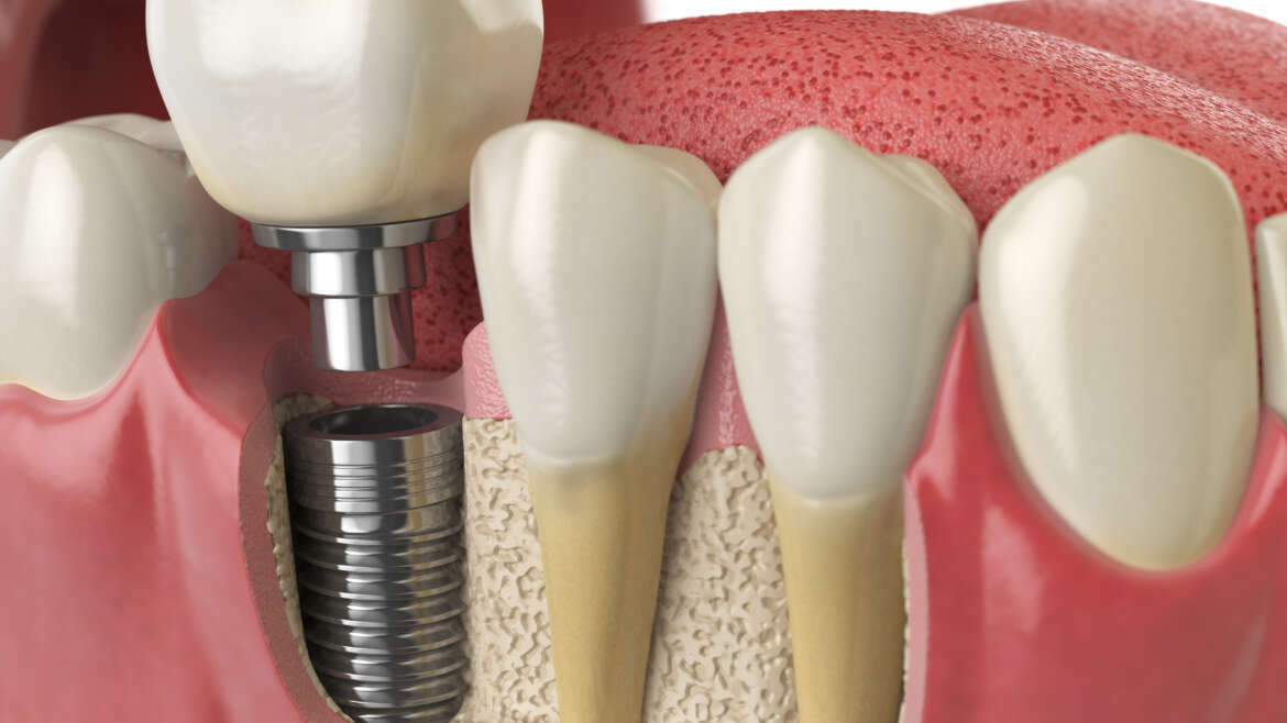 DENTAL IMPLANT