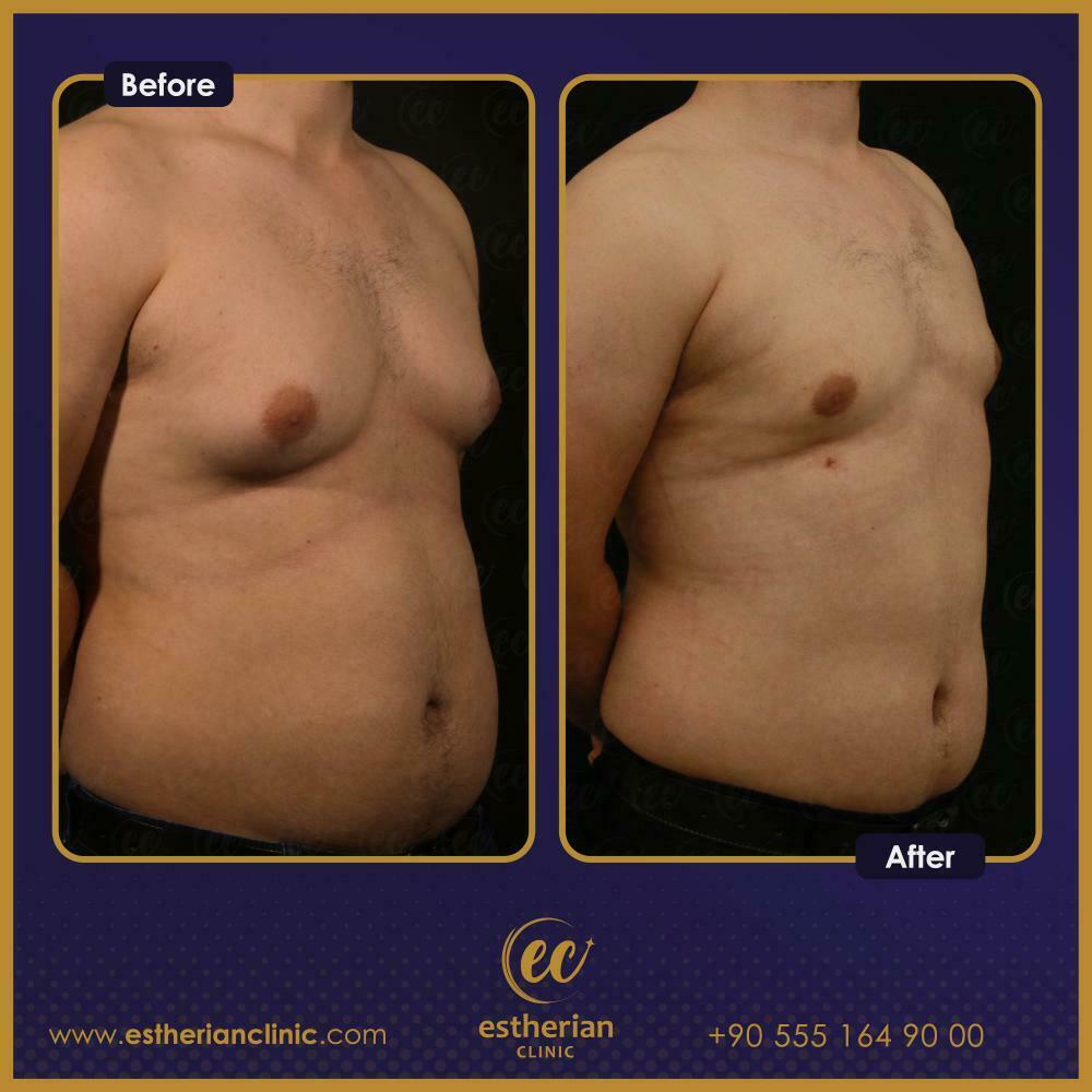 gynecomastia