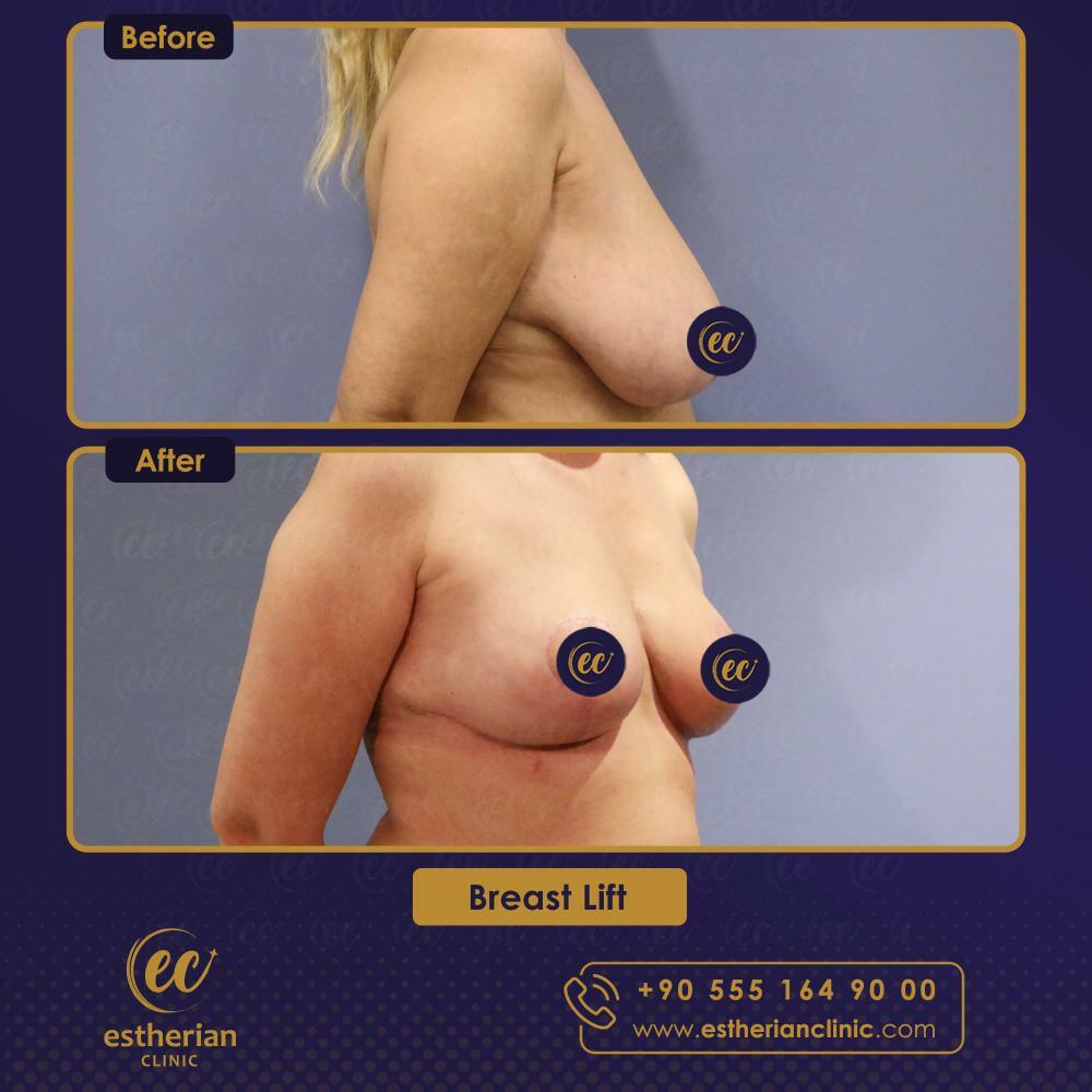 breast lift surgery