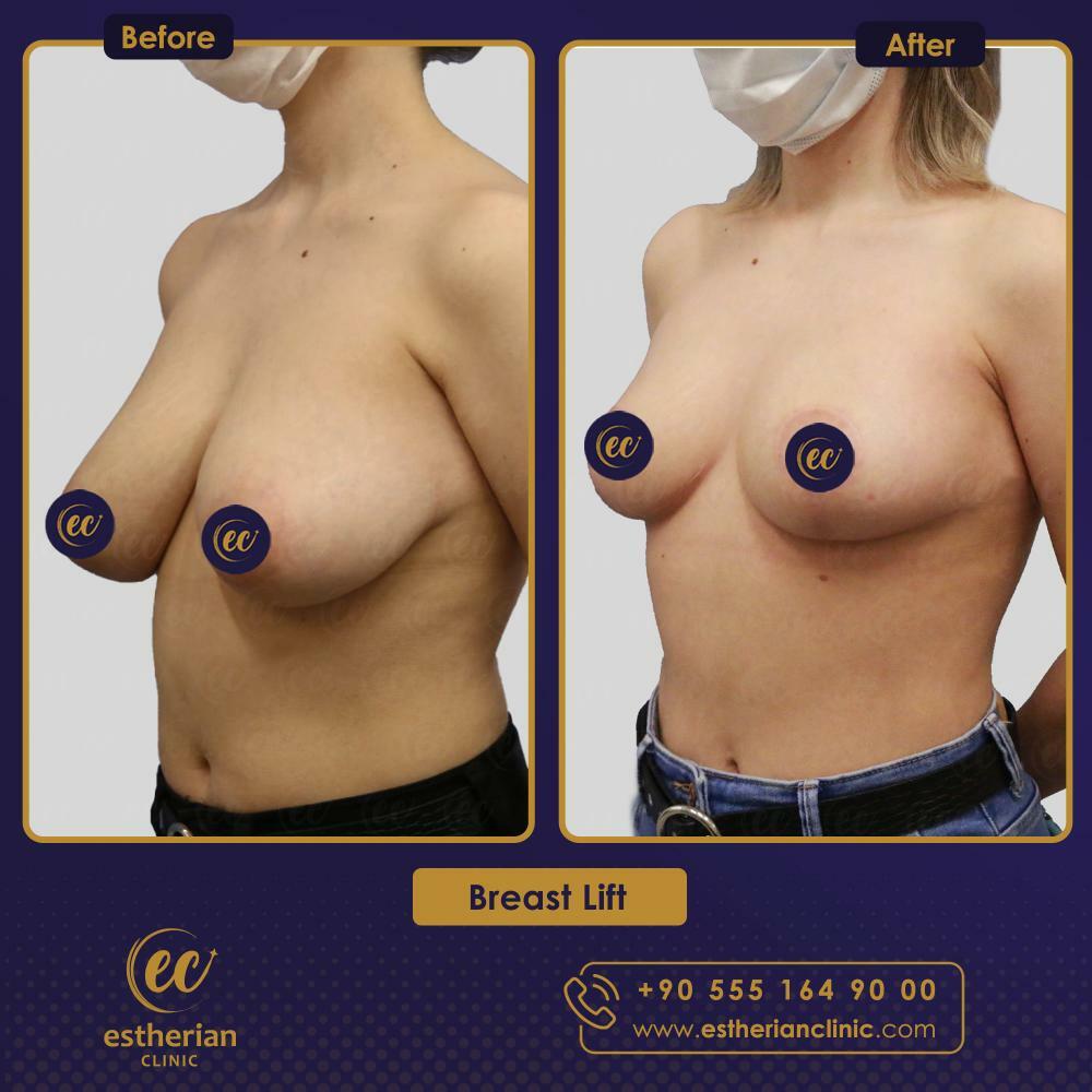 breast lift surgery