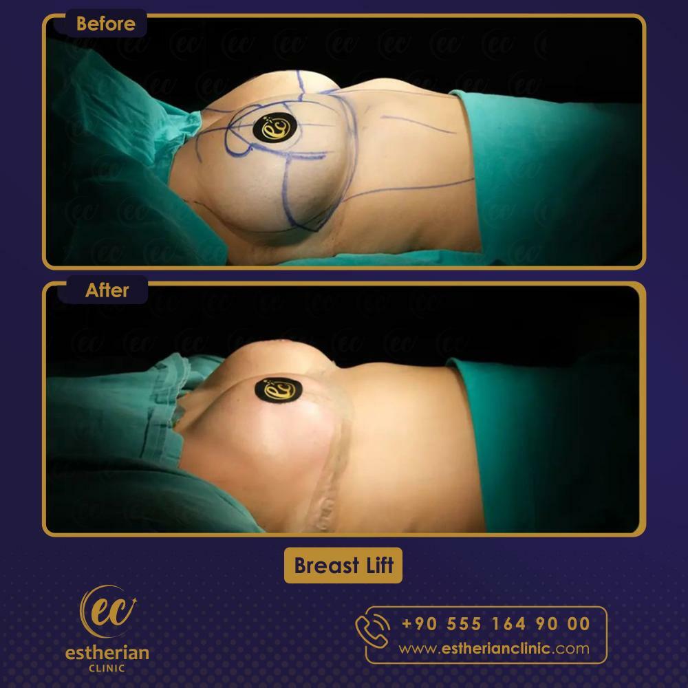 breast lift surgery