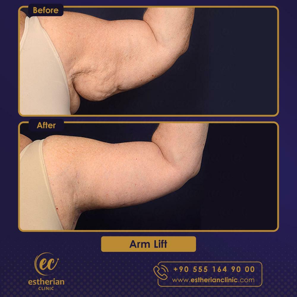 ARM LIFT