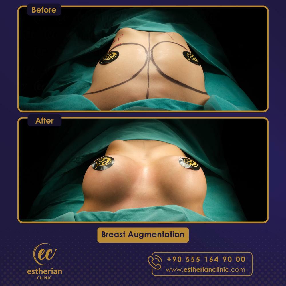 BREAST AUGMENTATION