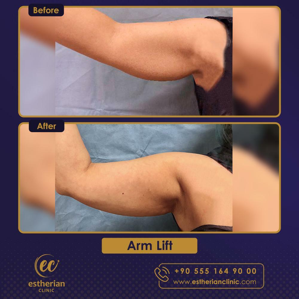 ARM LIFT