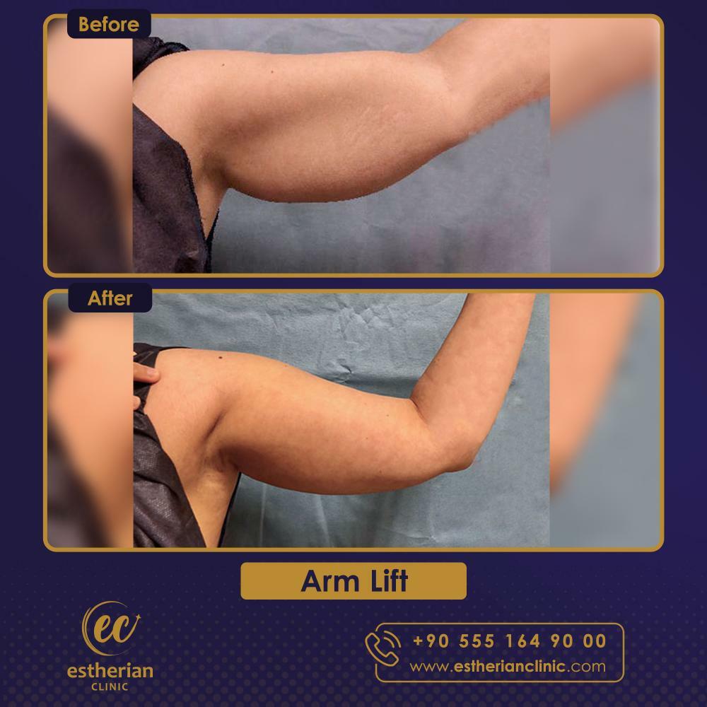 ARM LIFT