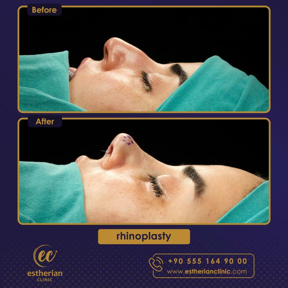 RHINOPLASTY