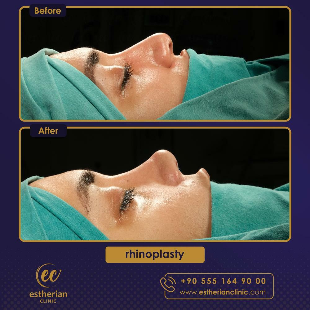 RHINOPLASTY