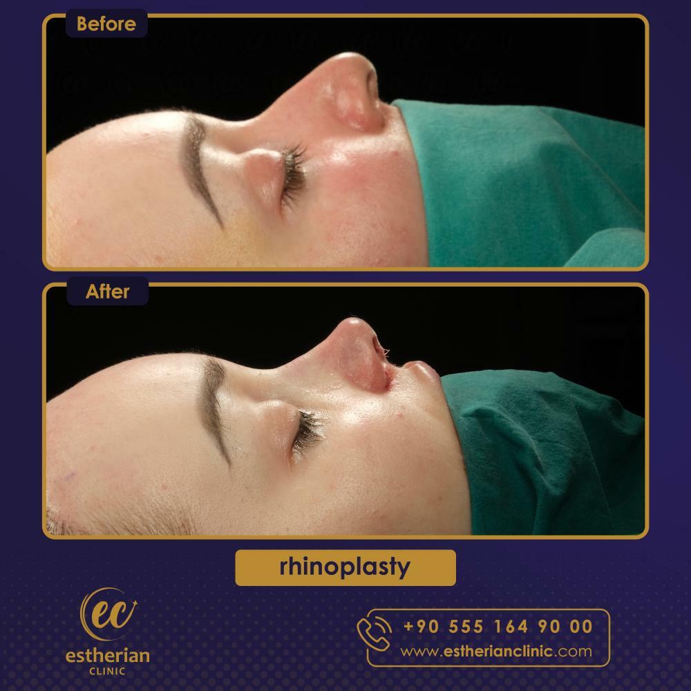 RHINOPLASTY