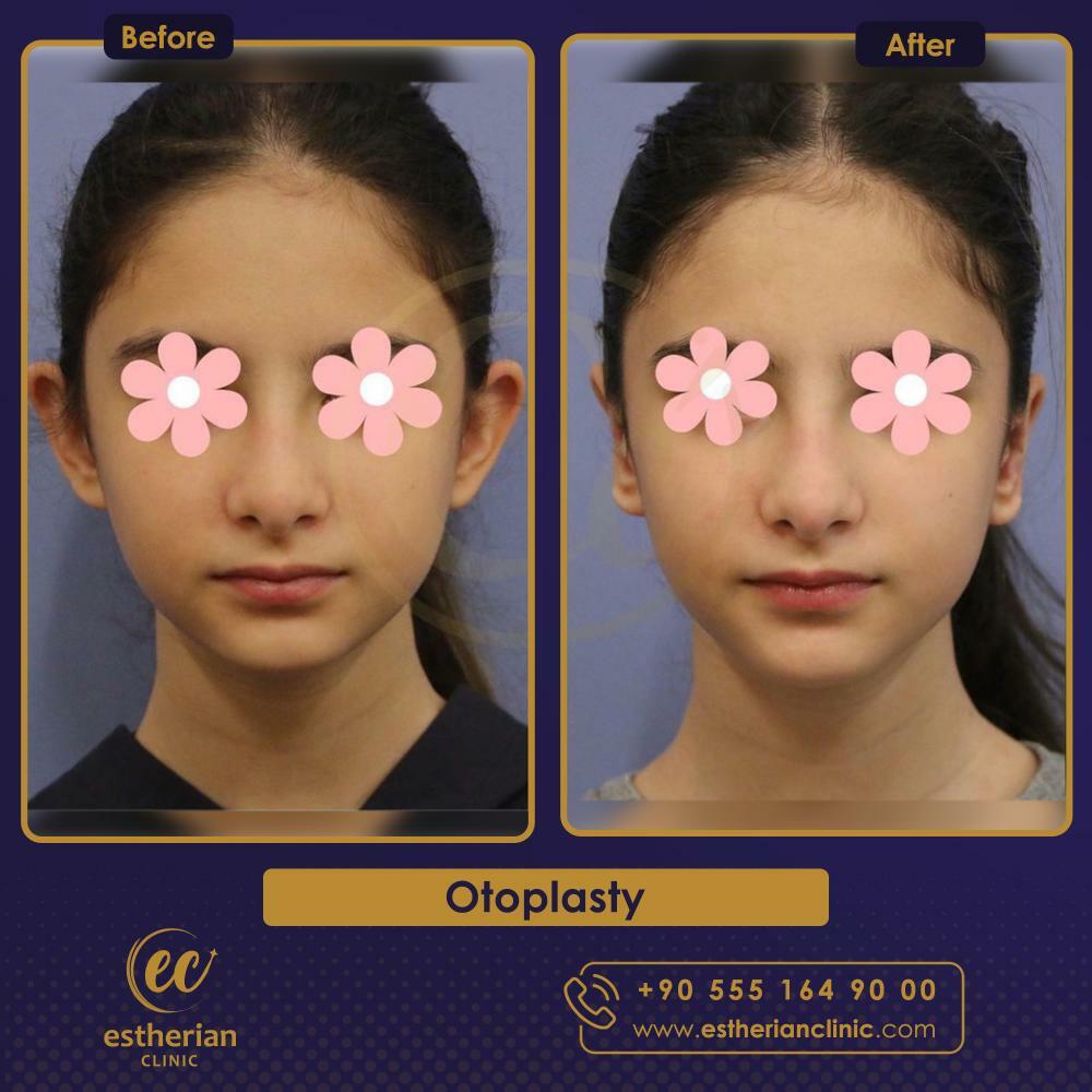 otoplasty