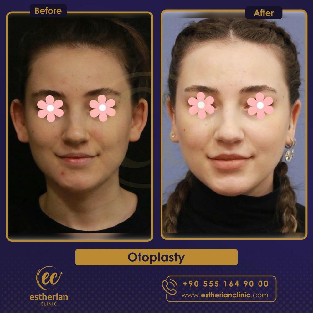 otoplasty