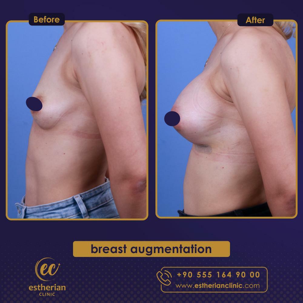 BREAST AUGMENTATION