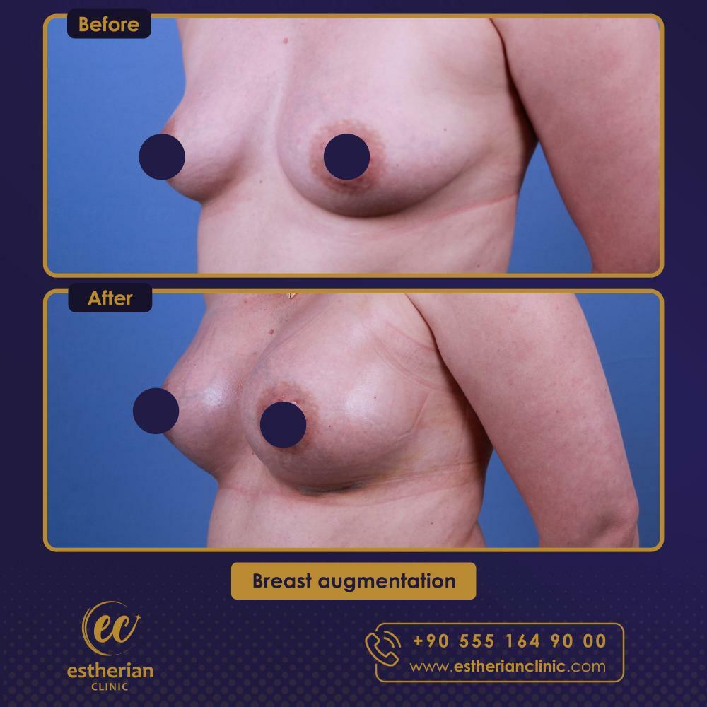 BREAST AUGMENTATION