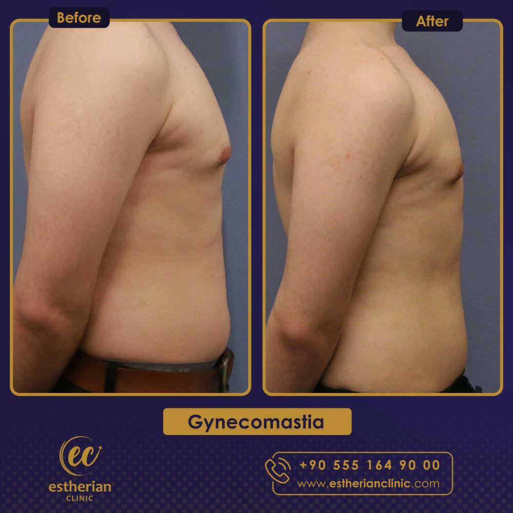 gynecomastia