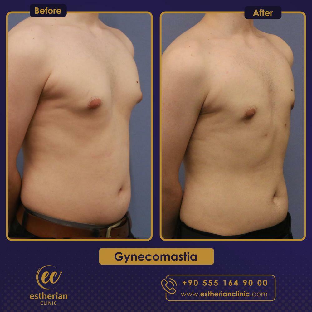 gynecomastia