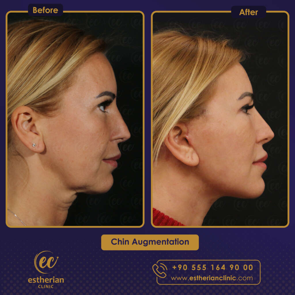 CHIN AUGMENTATION