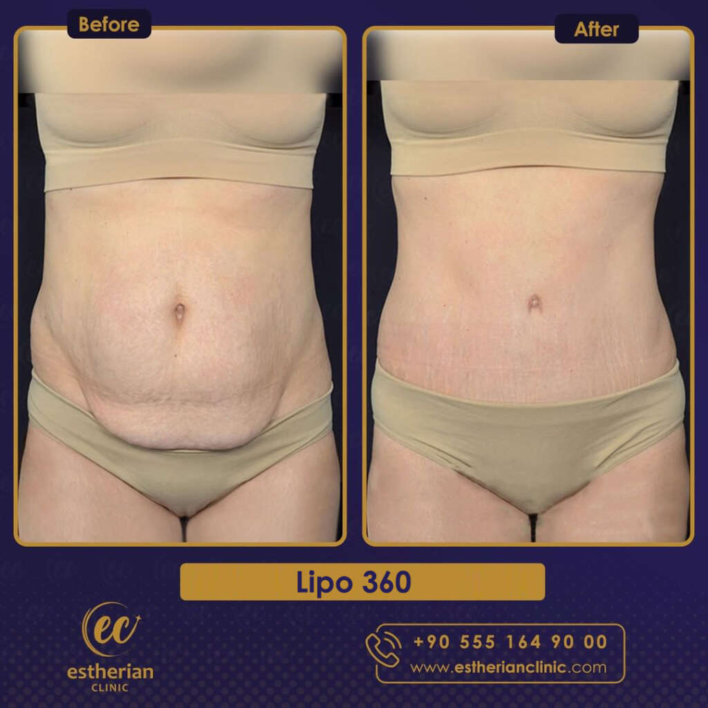 360 lipo