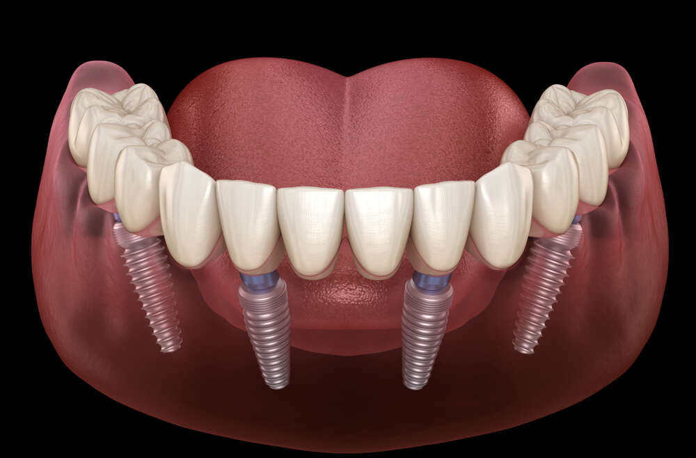 All-on-4 or All-on-6 dental implants