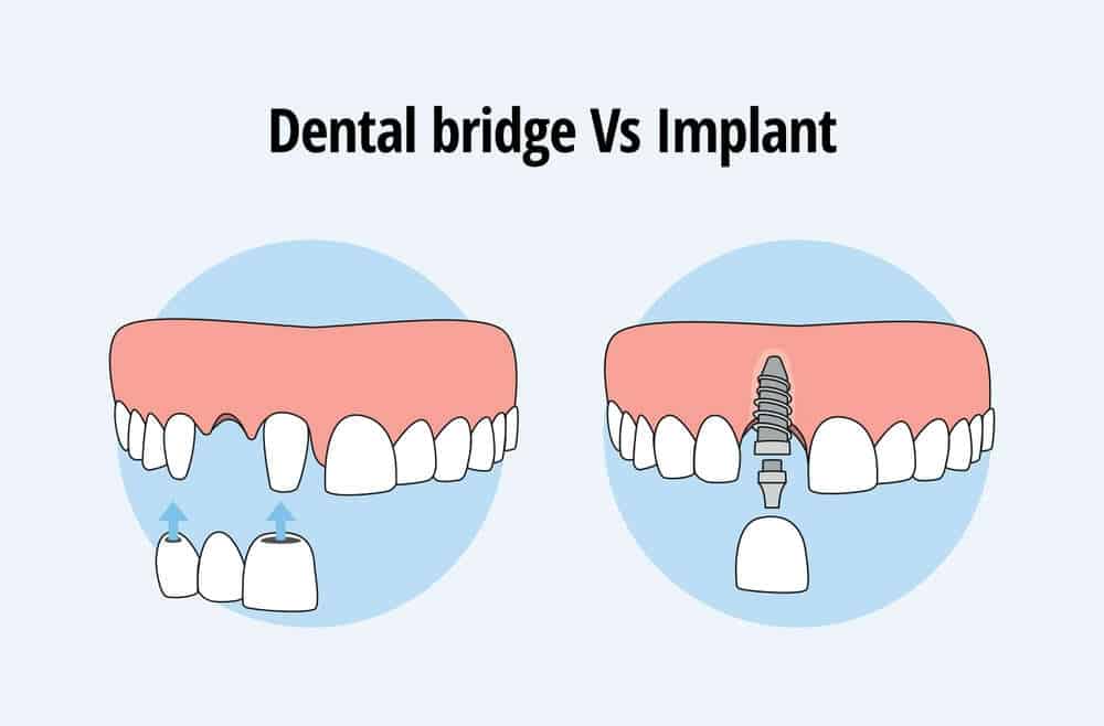 Dental crown vs Bridge