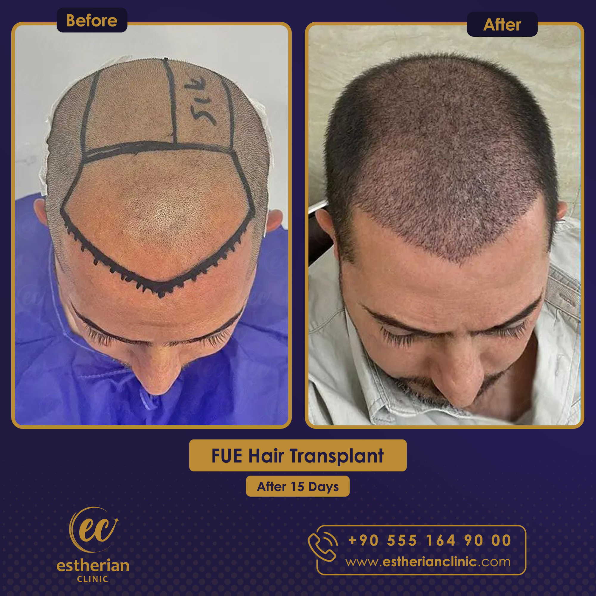 fue hair transplant