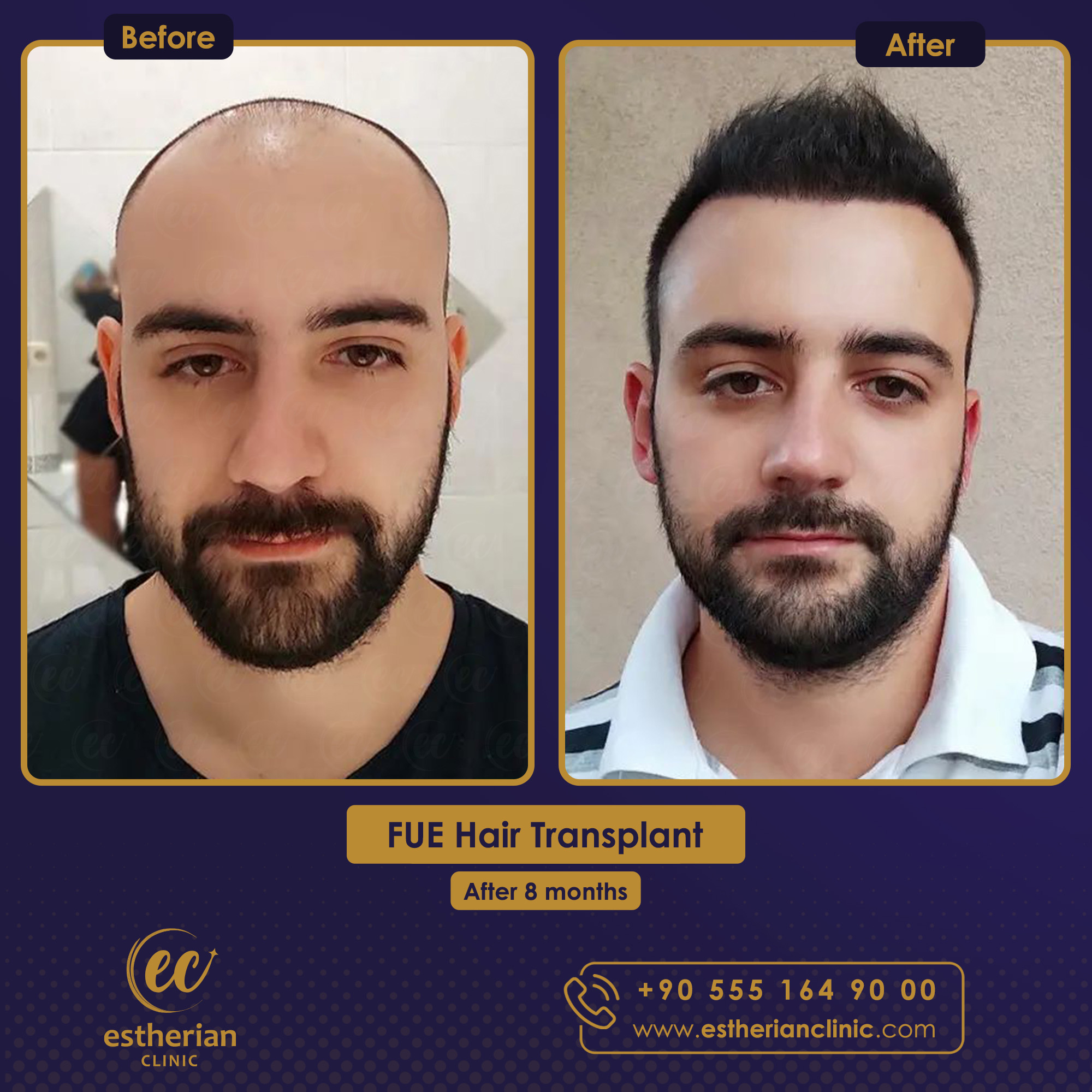 fue hair transplant