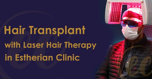 Laser Therapy for Hair Transplant: A Complete Guide