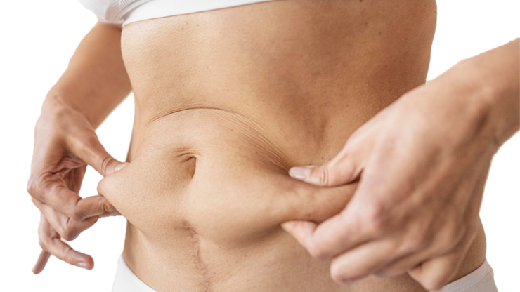 Tummy Tuck vs. Liposuction: Options for a Flat Stomach