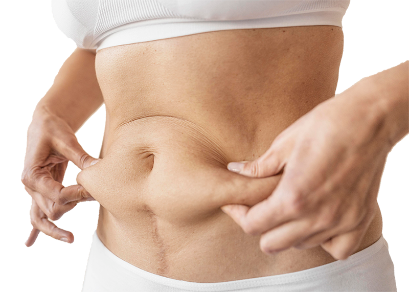 Do I need a mini tummy tuck?