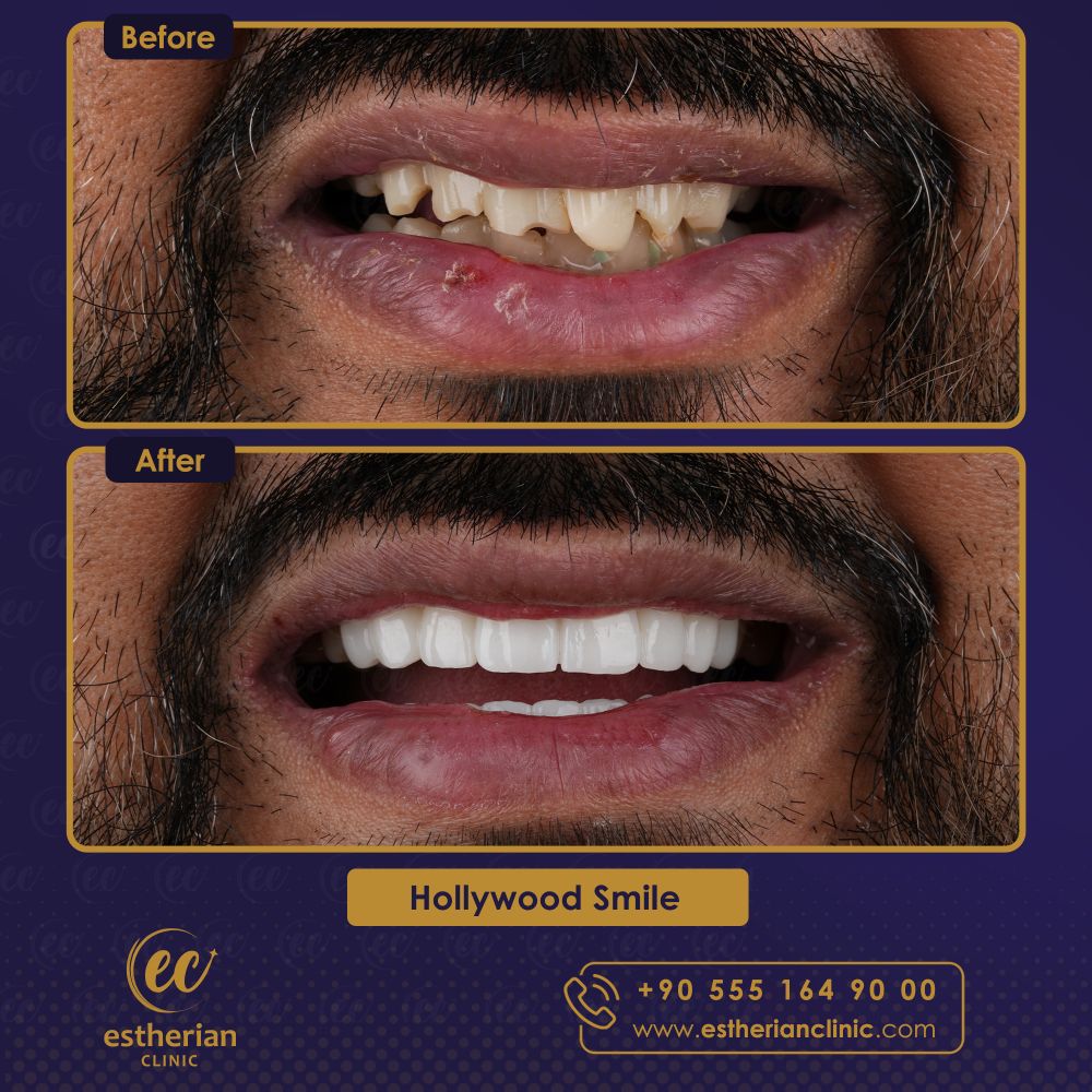 Hollywood smile results in Turkey