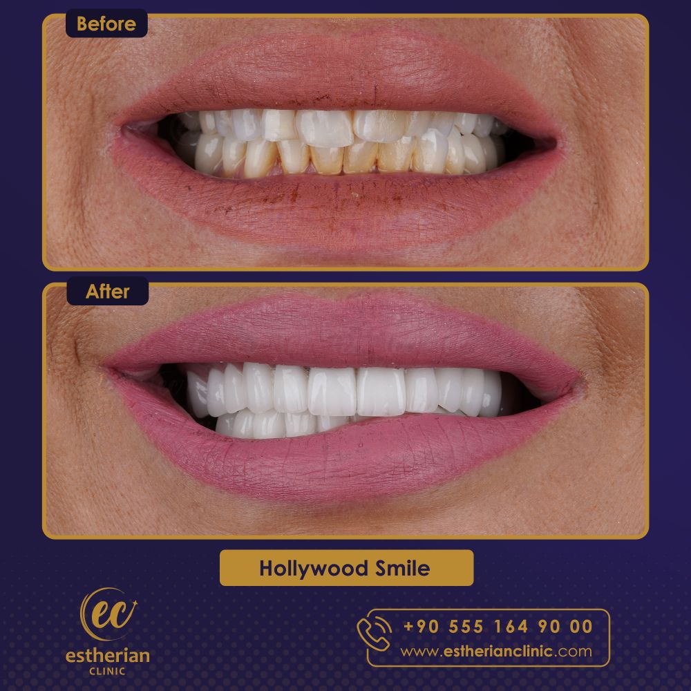 Hollywood smile results in Turkey