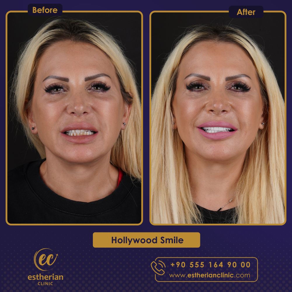 Hollywood smile results in Turkey