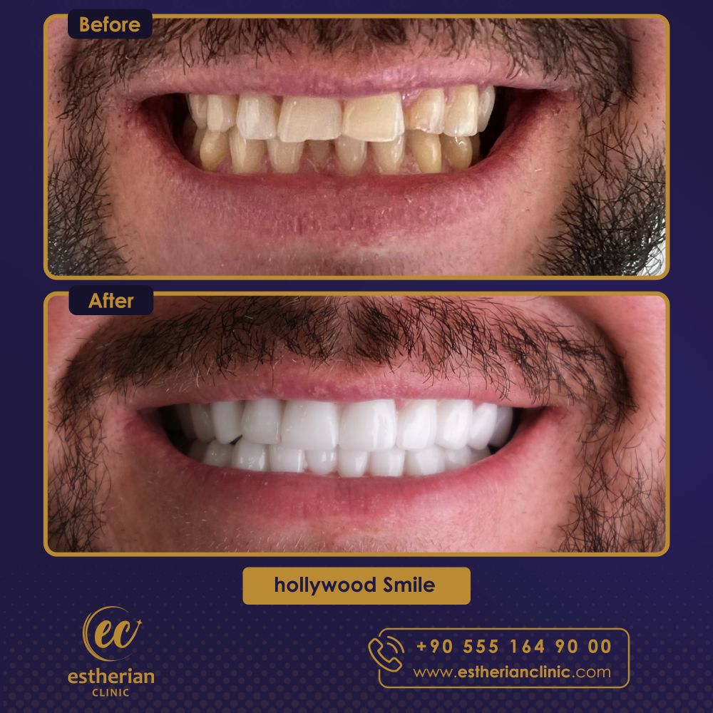 dental treatment results in Turkey