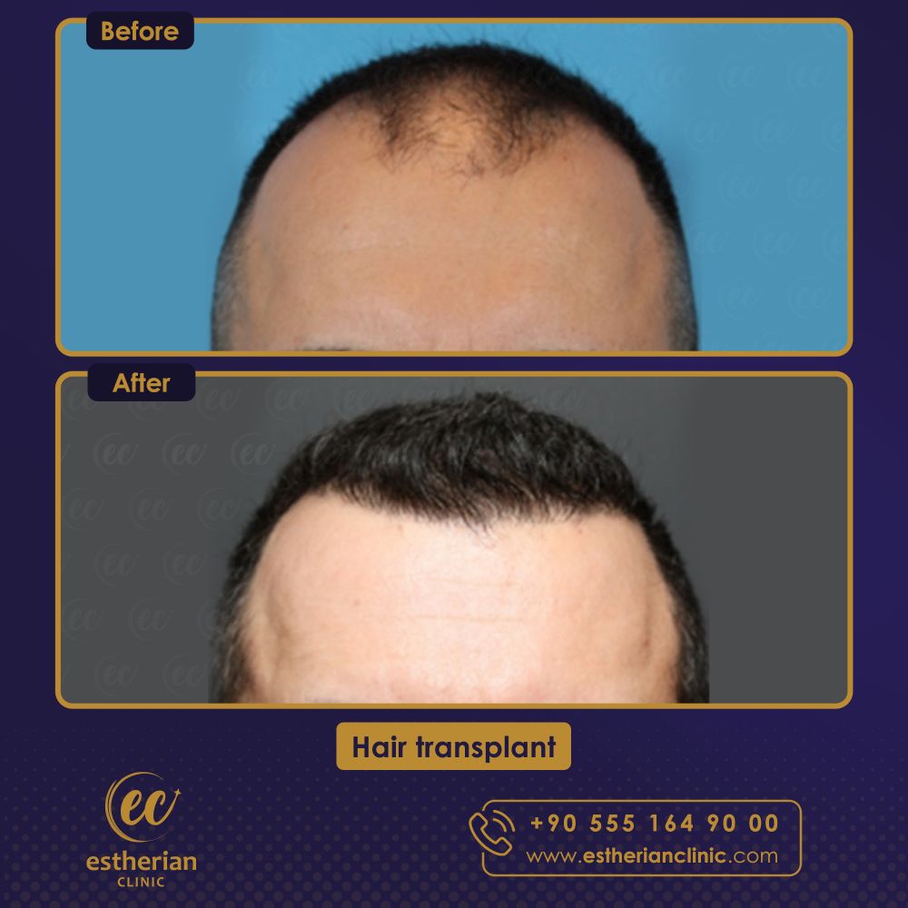 Hair Transplant