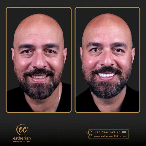 Hollywood smile results in Turkey