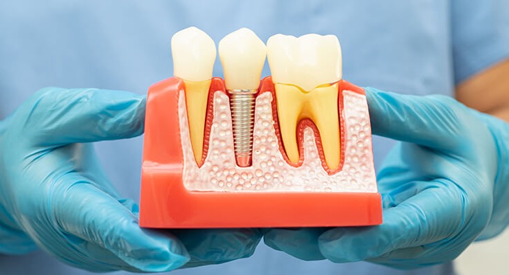 Dental Implant Technologies