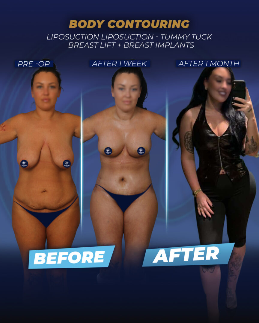 Body Contouring (Patient Success Story) by the Estherian Clinic