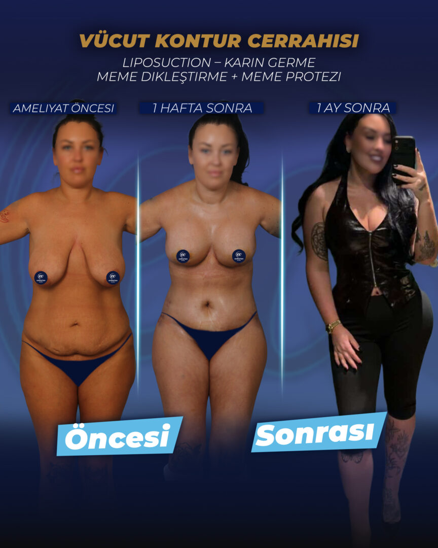 Estherian Kliniği'nden Vücut Şekillendirme (Hasta Başarı Öyküsü)