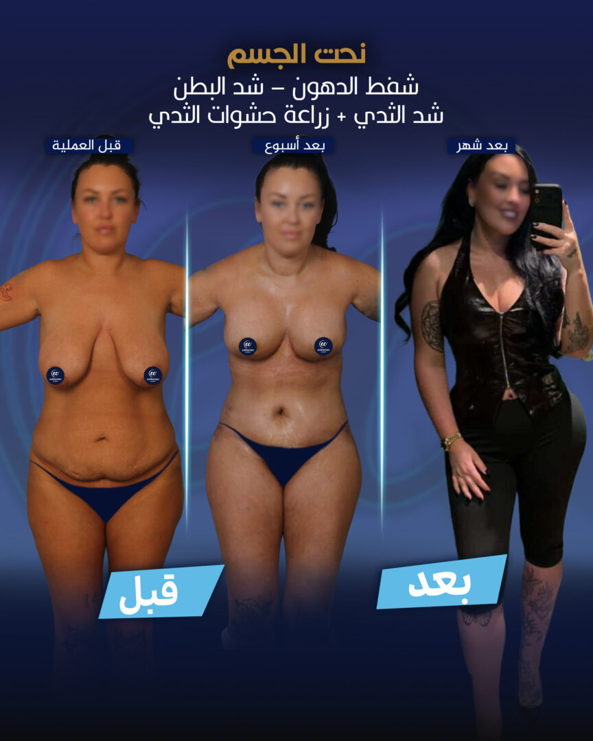 نحت الجسم (قصة نجاح مريض) من عيادة إستيريان