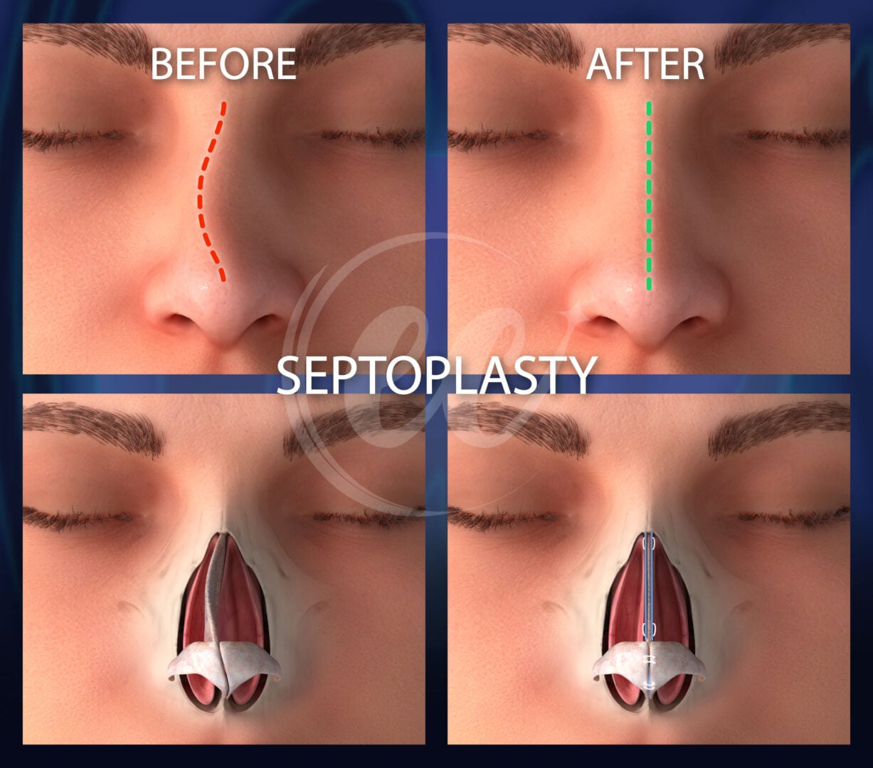 Septoplasty-Before-After-Infographic
