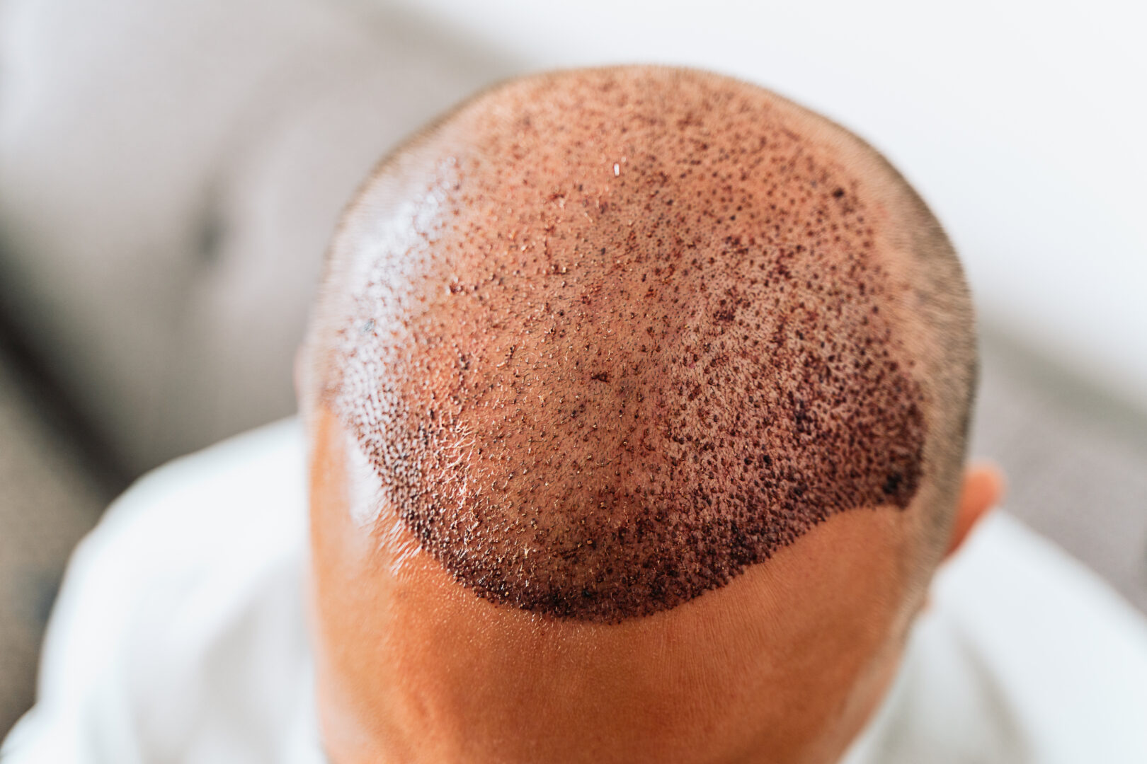 After Hair Transplant