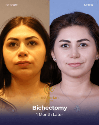 Bişektomi Sonuçları: 1 Ay Sonra