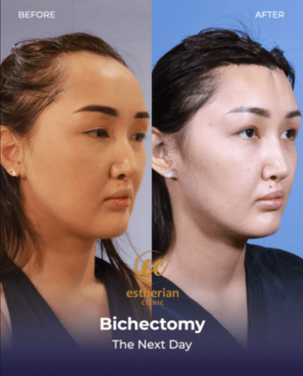 Bichectomy Results: Next Day