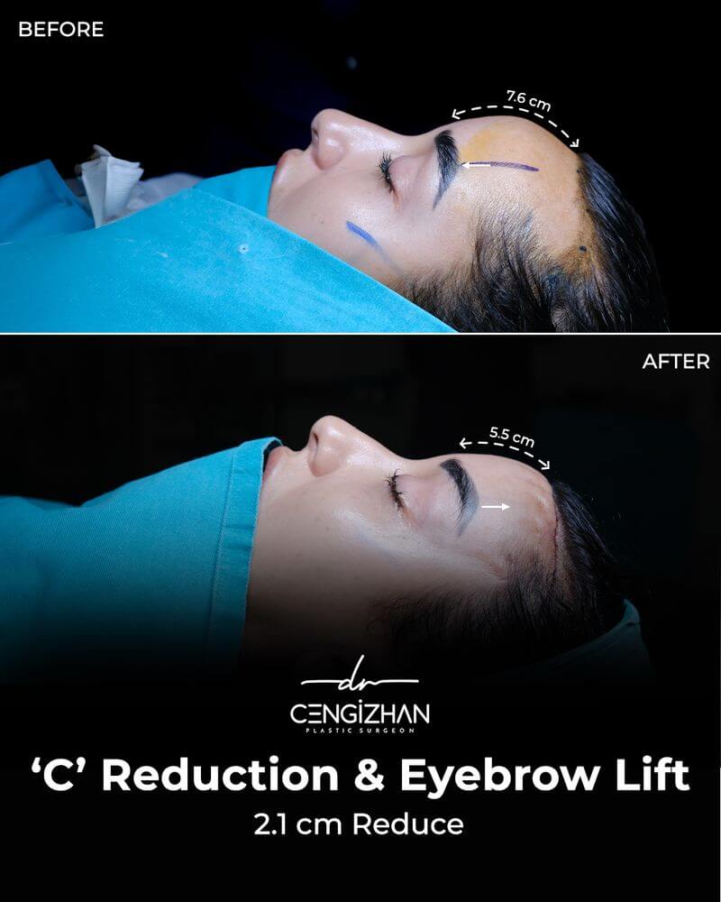 C Reduction & Eyebrow Lift