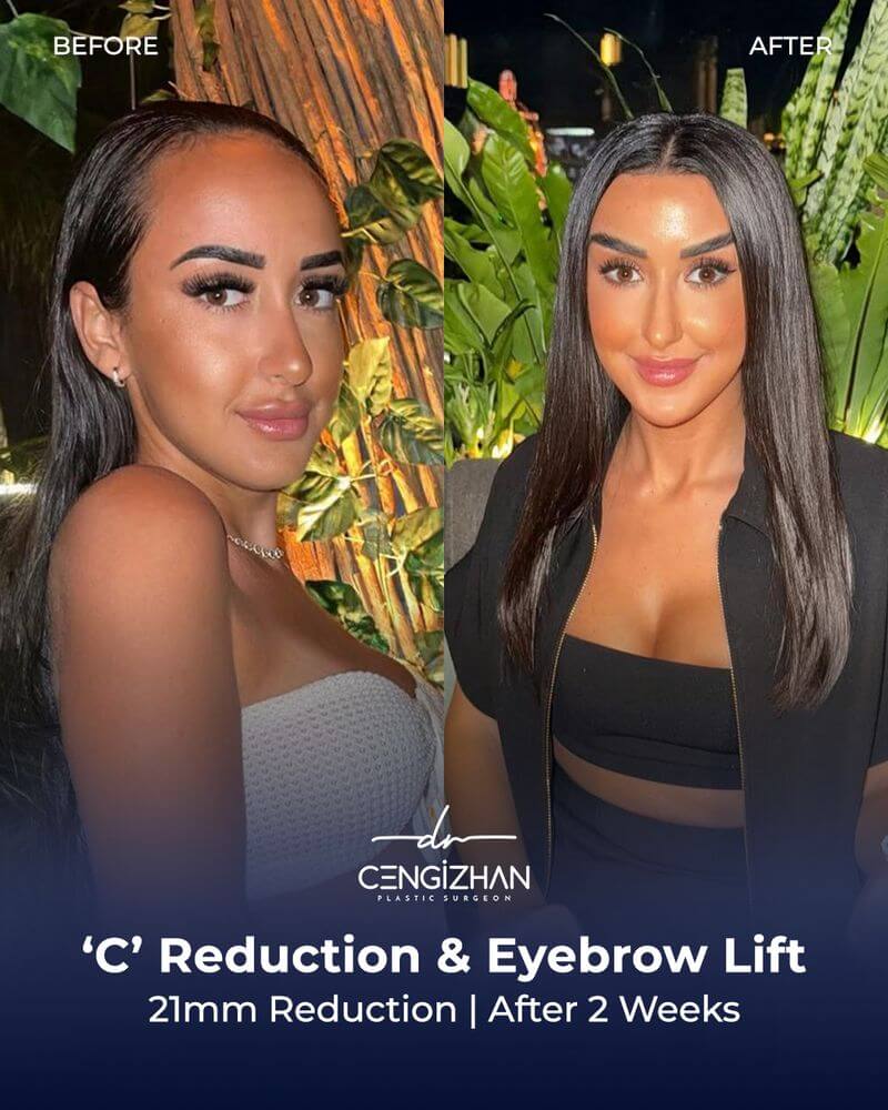 C Reduction and Eyebrow Lift (After 2 weeks)