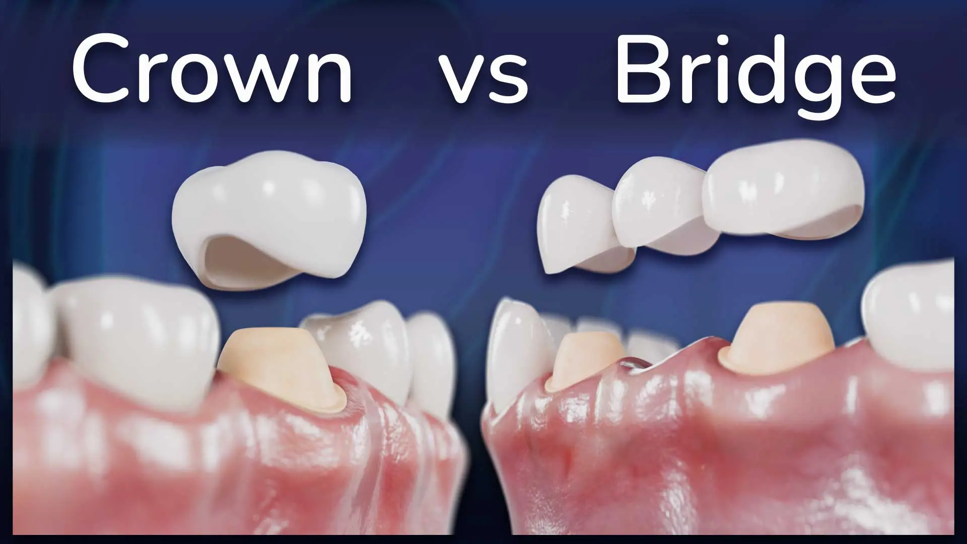 Crown vs Dental Bridge