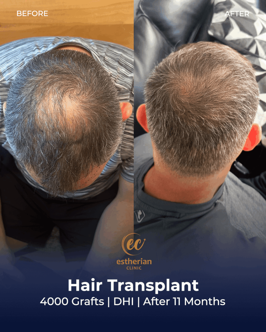 DHI Hair Transplant by Estherian Clinic (After 11 Months)
