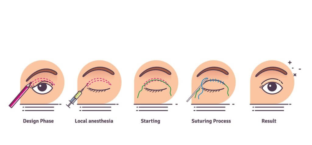 حقوق الصورة لجراحة الجفن المزدوج: allureplasticsurgery