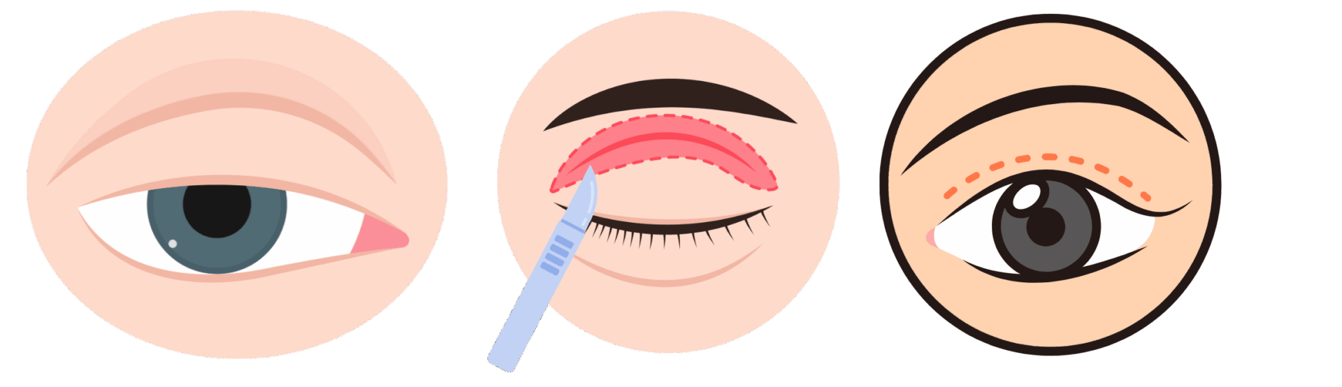 Eyelid Lift Surgery