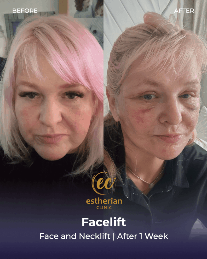 Face and neck lift after 1 week 