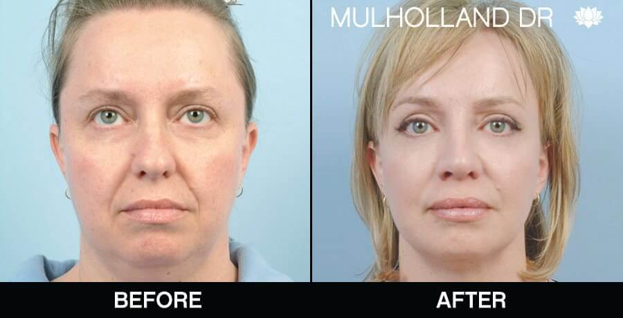 Facial Fat Grafting (before and after) image credits: The Toronto Plastic Surgeons